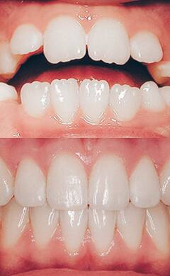 Zähne vorstehende Prognathie